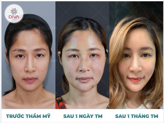 TIÊM MỠ COLEMAN TRÁN: CẢI THIỆN TRÁN LÕM, HỒI XUÂN TỰ NHIÊN