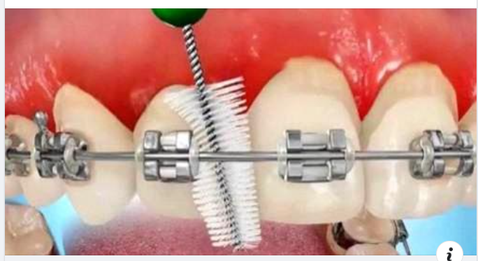 Tại sao nên dùng bàn chải kẽ răng cho răng niềng?