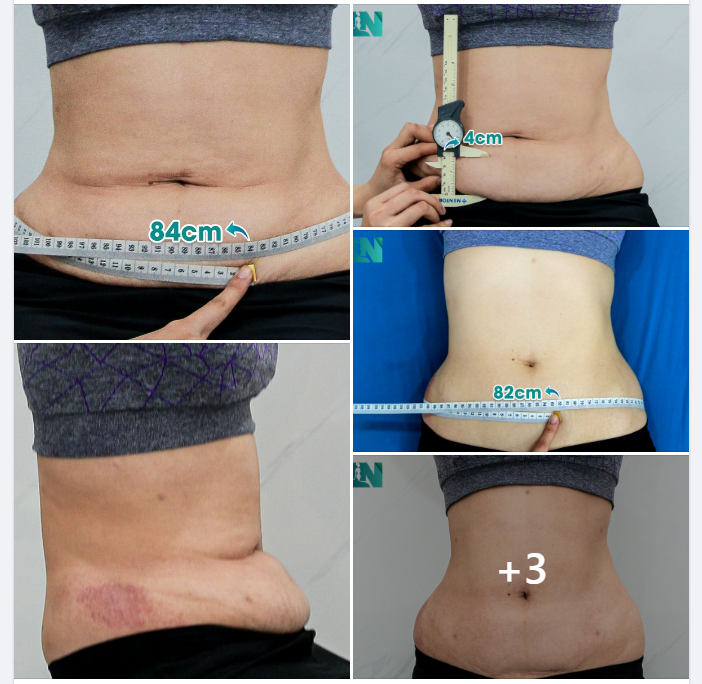 CHỊ KH 9X: TIN TƯỞNG LỰA CHỌN GIẢM MỠ TẠI EKIP BÁC SĨ LƯƠNG NGỌC VÌ ĐƯỢC NGƯỜI THÂN GIỚI THIỆU. 
