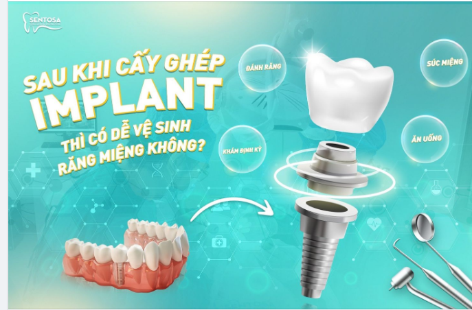 SAU KHI CẤY GHÉP IMPLANT THÌ CÓ DỄ VỆ SINH RĂNG MIỆNG KHÔNG?