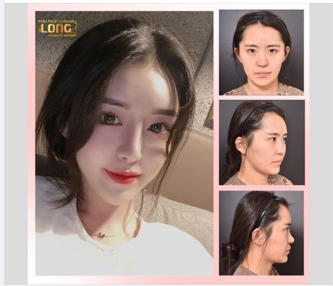 NÂNG MŨI SIÊU XINH TỰ TIN ĐU IDOL BLACK PINK