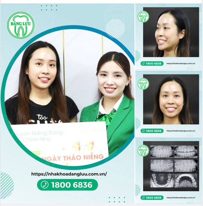 MỪNG THÁO NIỀNG: Tạm biệt răng thưa, chen chúc