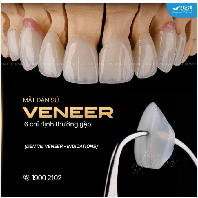 MẶT DÁN SỨ VENEER: 6 CHỈ ĐỊNH THƯỜNG GẶP