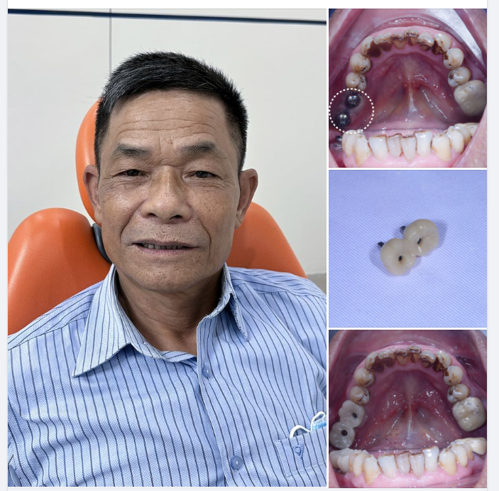 TRỒNG RĂNG IMPLANT PHỤC HÌNH TỨC THÌ- GIẢI PHÁP LÀM HÀI LÒNG NGAY CẢ NHỮNG KHÁCH HÀNG KHÓ TÍNH NHẤT !