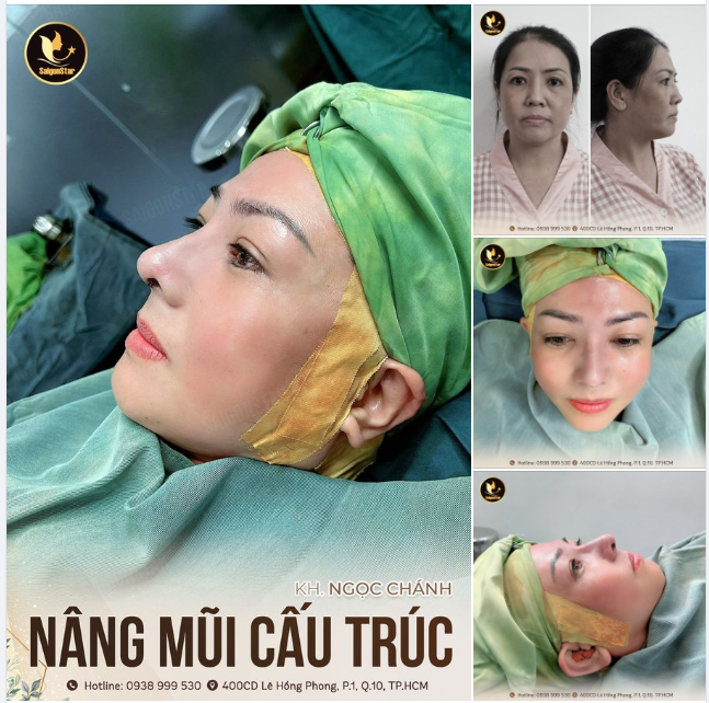 NÂNG MŨI CẤU TRÚC SỤN SURGIFORM