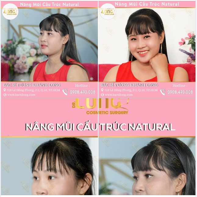 DÁNG MŨI NĂM ĐÓ TỪNG “NÂNG” HIỆN TẠI NHƯ THẾ NÀO