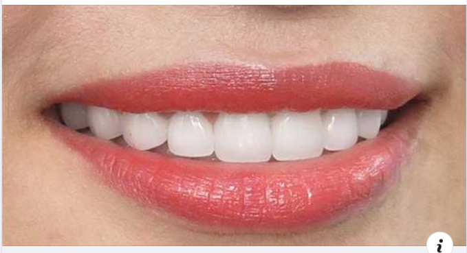 Bọc răng sứ giữ được bao lâu và hướng dẫn chăm sóc sau bọc răng