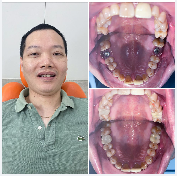 TRỒNG RĂNG IMPLANT XÂM LẤN TỐI THIỂU - LÀM MỘT LẦN, ĂN NHAI TRỌN ĐỜI !
