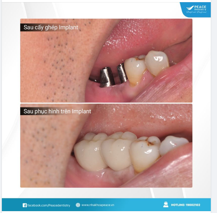 Trong nha khoa hiện đại, phương pháp cấy ghép Implant đã có nhiều tiến bộ đáng kể.