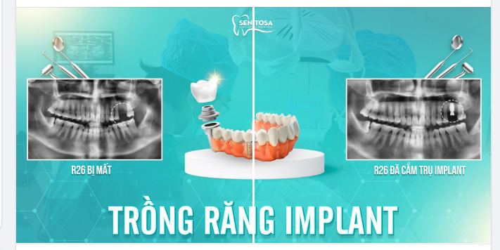  TRỒNG RĂNG IMPLANT, TẶNG CHA MẸ MÓN QUÀ NHƯ Ý
