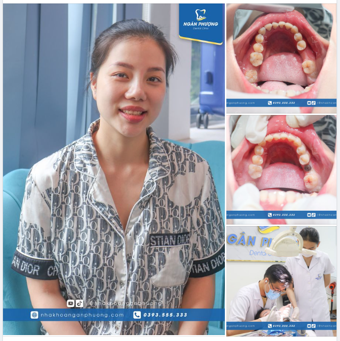 Flapless implant là phương pháp trồng răng nhanh chóng, không đau rất phổ biến hiện nay.