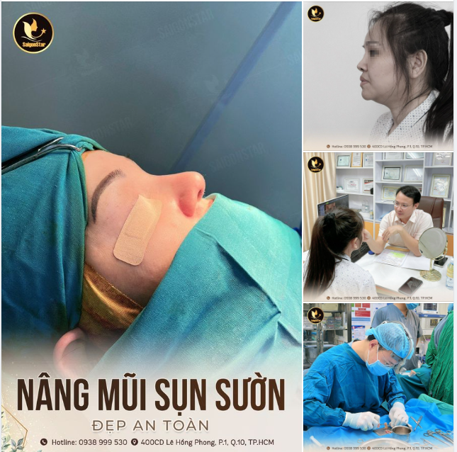 Đã từng nâng mũi 1 lần, thế nhưng đến thời điểm hiện tại, dáng mũi cũ không còn đẹp cũng như đi kèm biến chứng lộ song, khuyết cánh mũi.