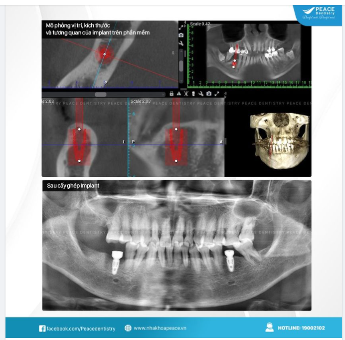 TRỒNG RĂNG IMPLANT - VÌ SAO PHẢI CHỌN NHA KHOA UY TÍN?