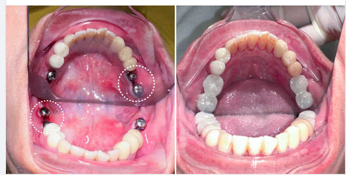 Chị Nguyễn Thị Hường (1982) đi hơn 100km từ Phú Thọ đến với nha khoa Quốc Tế Việt Mỹ trong tình trạng mất nhóm răng hàm hàm dưới lâu năm.