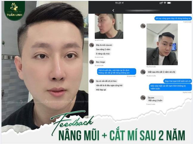 ''Bắt đền'' Tuấn Linh vì làm mũi, mí xong đi đâu ai cũng khen ĐẸP TRAI QUÁ!!