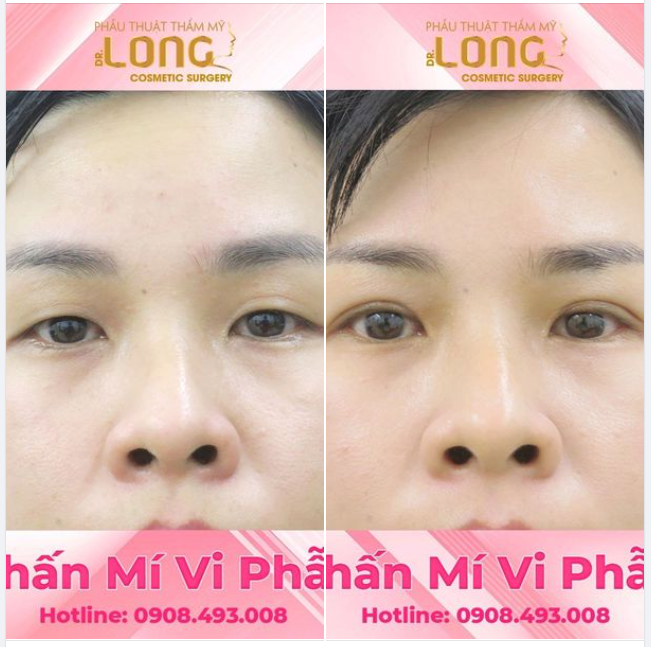 ĐÁNH THỨC “GIẤC MƠ” TRONG BẠN KHÔI PHỤC ÁNH NHÌN, TỰ TIN VỚI NÉT ĐẸP MỚI