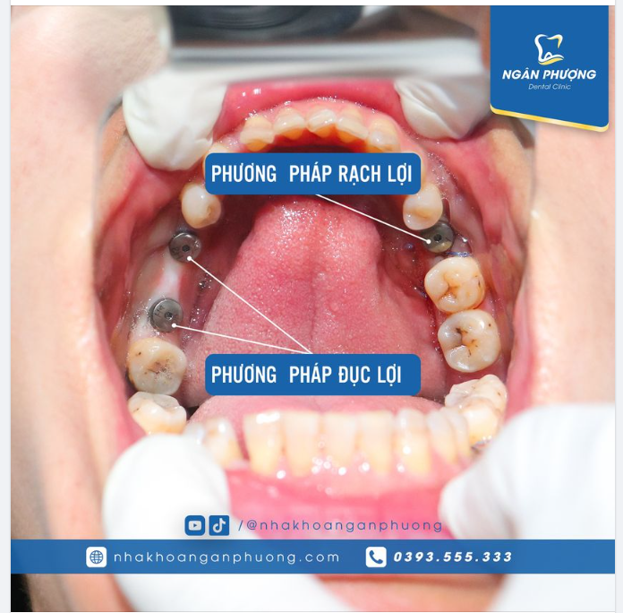 Trồng implant có thật là không đau, không chảy máu?
