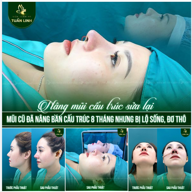 HẾT LỘ SỐNG, LỆCH SỐNG, HẾT ĐƠ THÔ - LỘT XÁC GÓC NGHIÊNG ĐẸP HOÀN HẢO!!