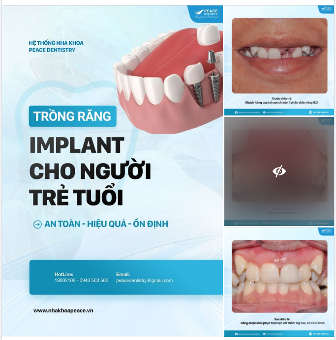 MẤT RĂNG Ở NGƯỜI TRẺ TUỔI