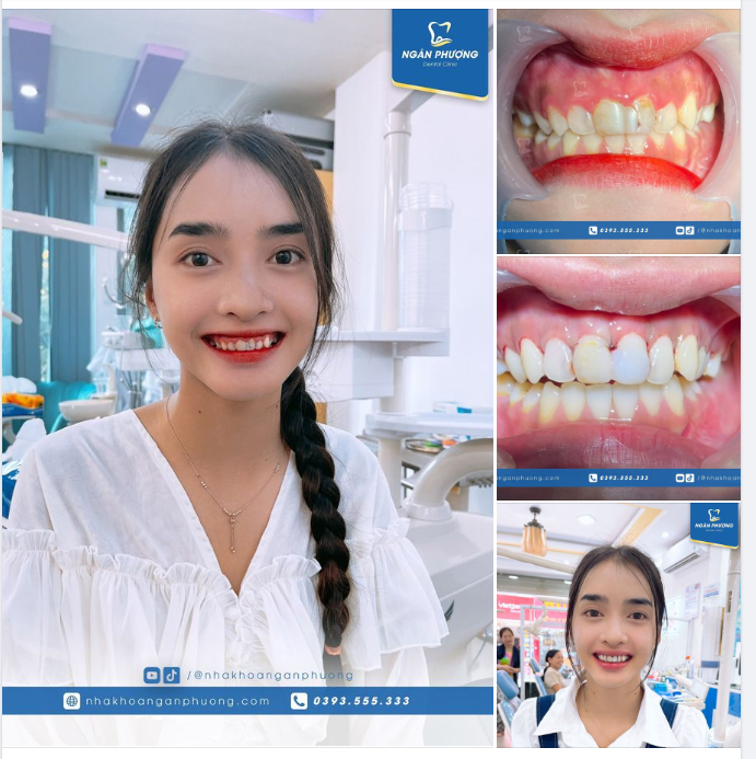 Răng em đẹp rồi mà, sao còn đi làm răng?