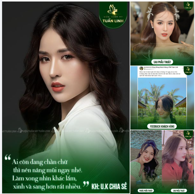 Khoe nhẹ một chiếc khách hàng Xinh Đẹp Nâng Mũi Angel line tại Tuấn Linh!!