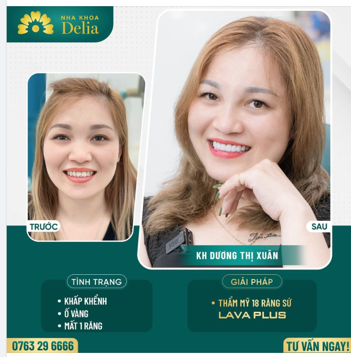 Xử lí răng khấp khểnh, ố vàng - Khách hàng tự tin khoe nụ cười đều đẹp, rạng rỡ