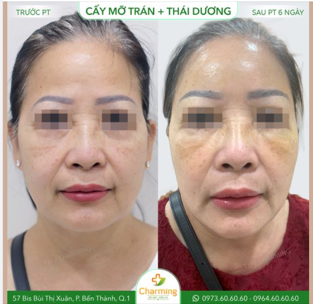 Cả cấy mỡ trán và cấy mỡ thái dương đều mang lại kết quả tuyệt vời trong việc tạo hình và giúp khuôn mặt trở nên tươi trẻ, cân đối hơn và hài hòa hơn.