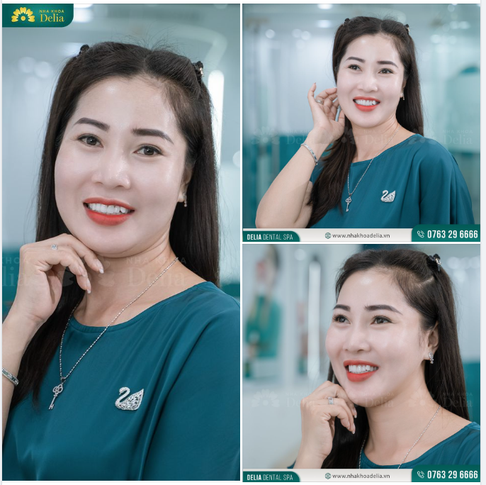 Kết quả thẩm mỹ 23 răng sứ Emax tại nha khoa Delia đã giúp chị Huyền sở hữu nụ cười trắng sáng đều đẹp mà vẫn giữ được nét răng khểnh duyên dáng như ý muốn.