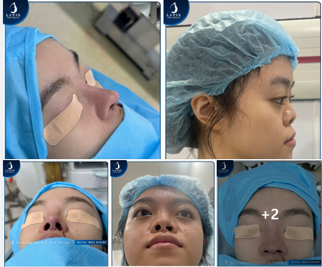 Kết quả XUẤT SẮC cho một ca mũi bị tật bẩm sinh và đã từng nâng mũi trước đó nhưng không thành công của bác sĩ và ekip tại Latin