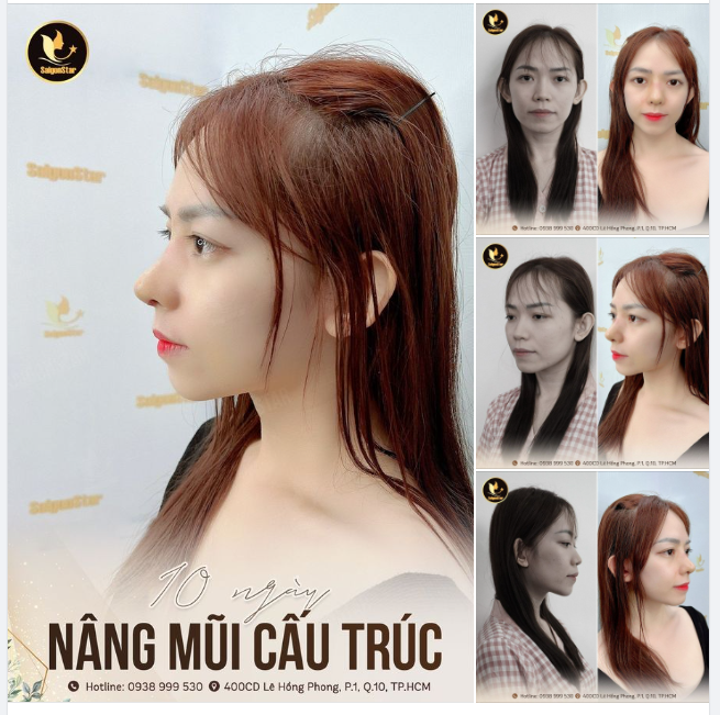 10 NGÀY NÂNG MŨI CẤU TRÚC