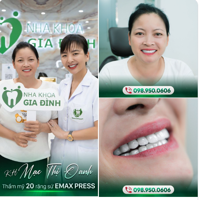 THAY VÌ BI QUAN VỚI HÀM RĂNG KHIẾM KHUYẾT, CHỊ OANH QUYẾT ĐỊNH THẨM MỸ RĂNG SỨ
