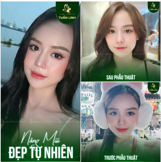 Gương mặt bạn khá xinh xắn nhưng nhạt nhòa, sau khi sở hữu chiếc mũi cao tự nhiên thì bạn xinh đẹp sắc nét và có điểm nhấn hơn rất nhiều.