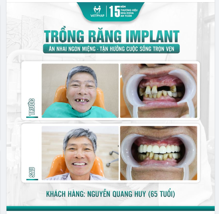 TRỒNG RĂNG IMPLANT - Khách hàng Nguyễn Quang Huy (65 tuổi)