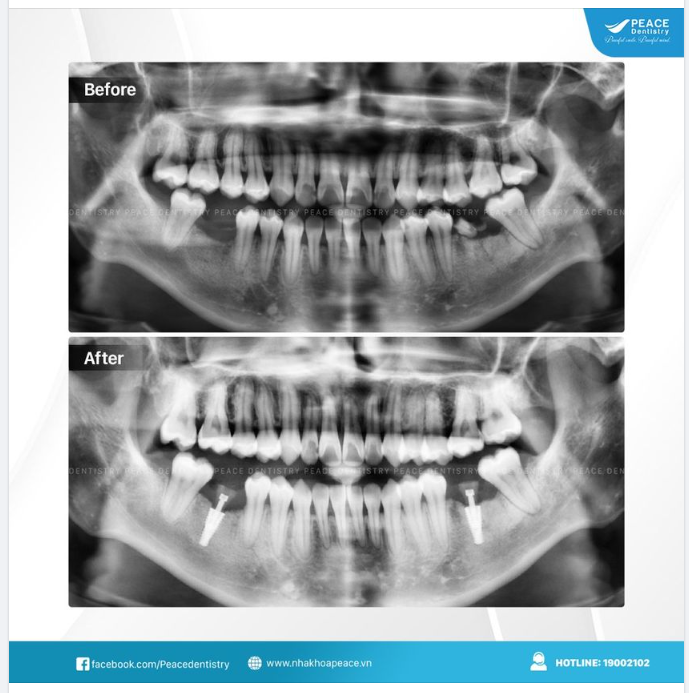 MẤT RĂNG HÀM SỐ 6 - IMPLANT LÀ LỰA CHỌN LÝ TƯỞNG, BỀN VỮNG CÙNG THỜI GIAN!