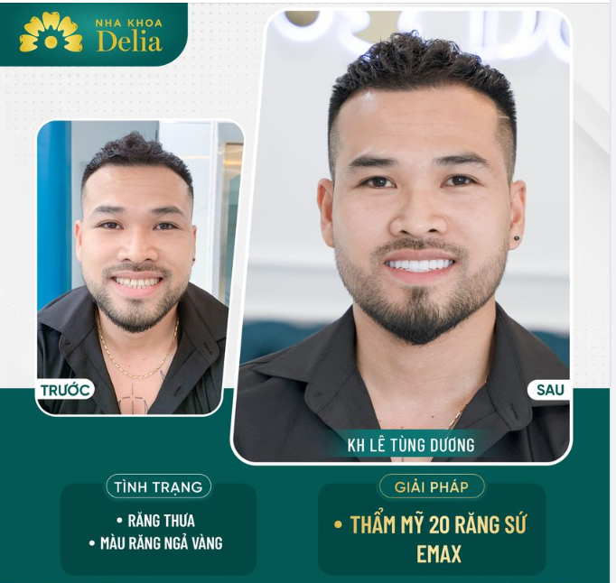 Kết quả thẩm mỹ đã giúp anh Tùng Dương sở hữu nụ cười đều đẹp như ý, màu sắc răng trắng sáng tự nhiên.