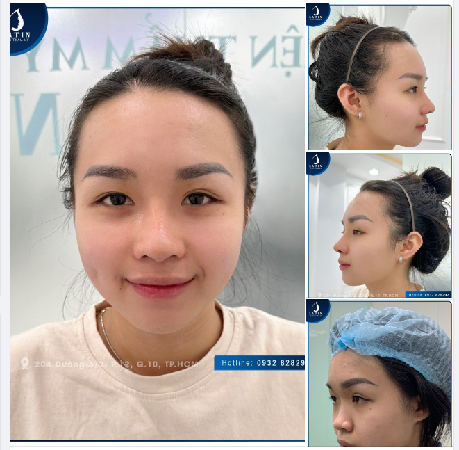 Mũi cấu trúc 10 ngày lên dáng SIÊU NÉT cho em gái