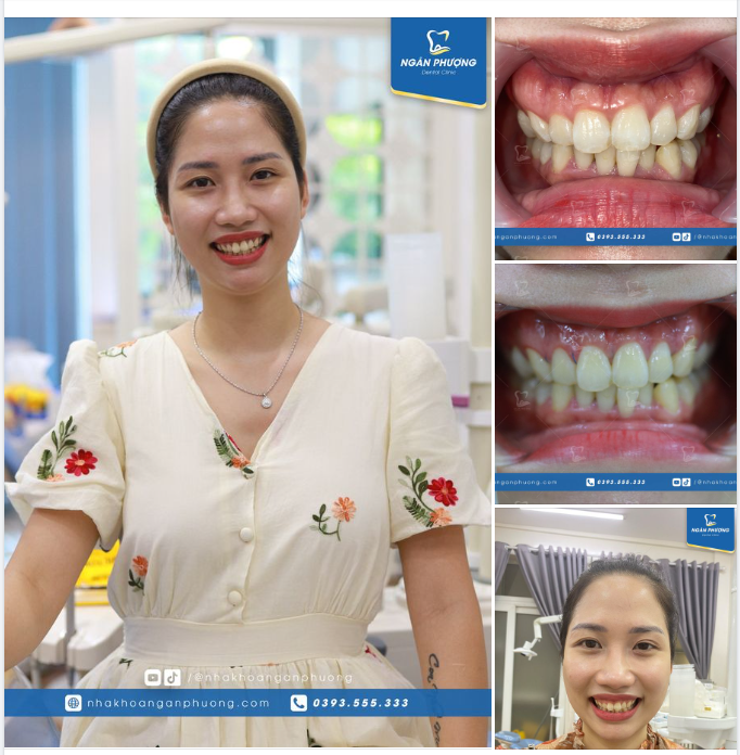 Câu chuyện của chị Trà My là ví dụ điển hình. Vốn dĩ chị có khuôn cười đẹp và được trời cho nhan sắc mặn mà, duyên dáng.