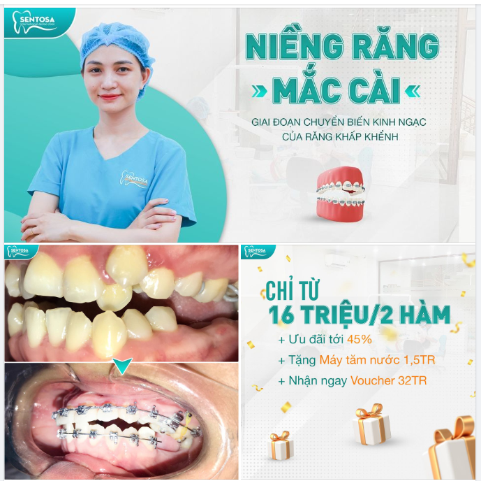 NIỀNG RĂNG MẮC CÀI: GIAI ĐOẠN CHUYỂN BIẾN KINH NGẠC CỦA RĂNG KHẤP KHỂNH