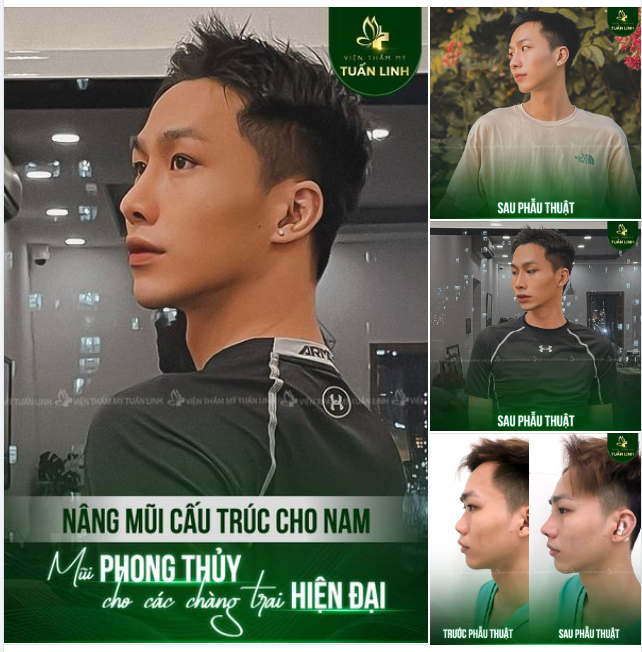 Nâng mũi nam - Nâng tầm tự tin cho các chàng trai hiện đại.