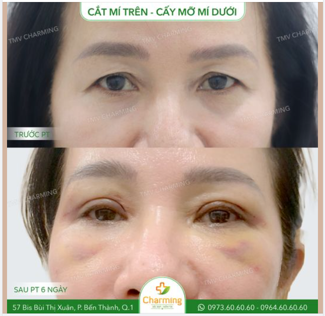Sụp mí là một trong những vấn đề khiến nhiều người đau đầu, trong đó có cả cô khách sau của Charming.