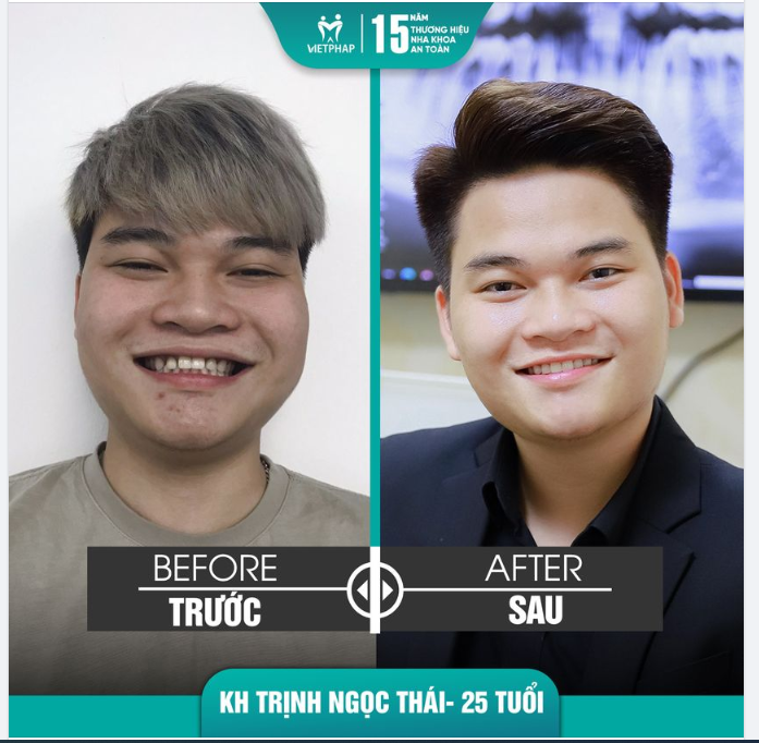 Thay đổi đáng kinh ngạc sau khi làm răng sứ tại Việt Pháp!