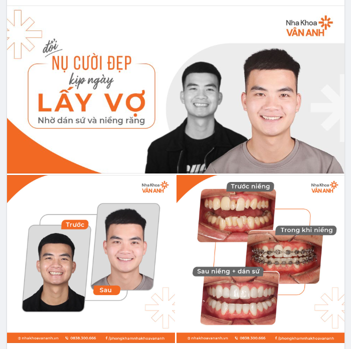 ĐỔI NỤ CƯỜI ĐẸP KỊP NGÀY LẤY VỢ >>> NHỜ DÁN SỨ VÀ NIỀNG RĂNG