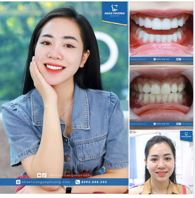 Chúc mừng chị đã có được nụ cười như ý