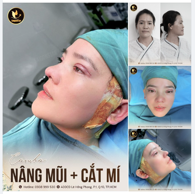 “FLEX” SƯƠNG SƯƠNG COMBO NÂNG MŨI + CẮT MÍ TẠI DR. HOẠT