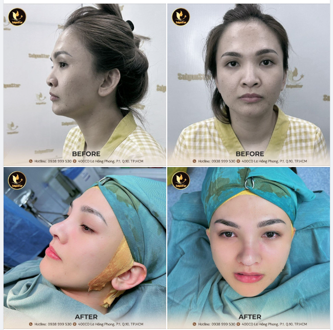 NÂNG MŨI CẤU TRÚC – XỬ LÝ CHỈ CŨ