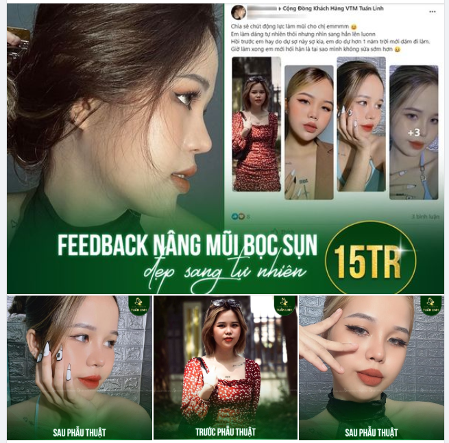 NÂNG MŨI BỌC SỤN- ĐẸP SANG TỰ NHIÊN