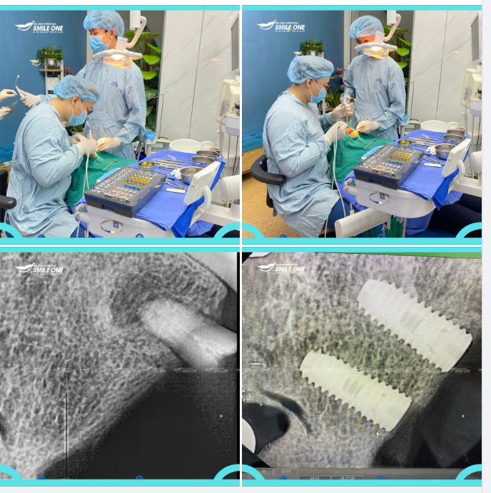 Trồng răng implant khách hàng Nguyễn Thanh Hằng 65 tuổi!