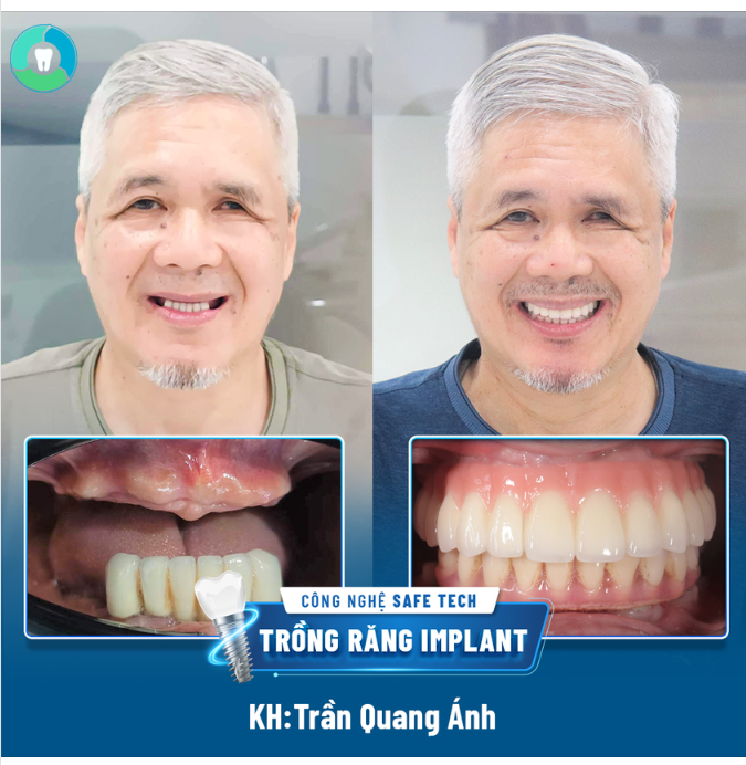 "MỘT KẾT QUẢ TRỒNG IMPLANT ĐÁNG ĐỒNG TIỀN BÁT GẠO..."