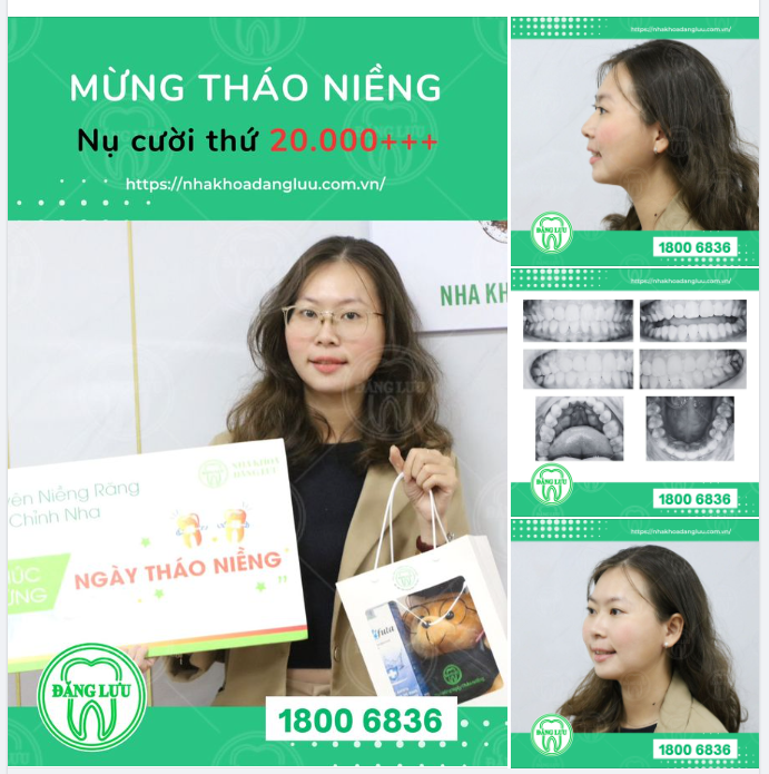 Kết thúc hành trình niềng răng tròn 2 năm