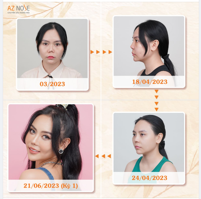 Dáng mũi "bình-thường-mới" sau 8 lần phẫu thuật thất bại